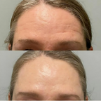 BotoxFace PREMIUM - Retire Imperfeições Faciais |COMPRE 1 LEVE 2| Frete Grátis